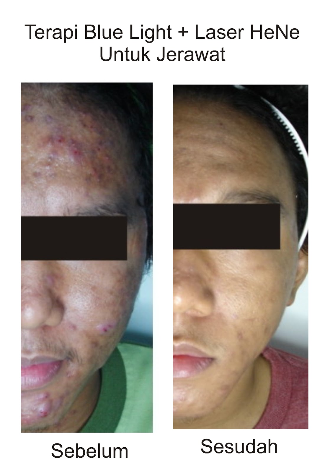 Combating Acne Combating Acne with Blue Light