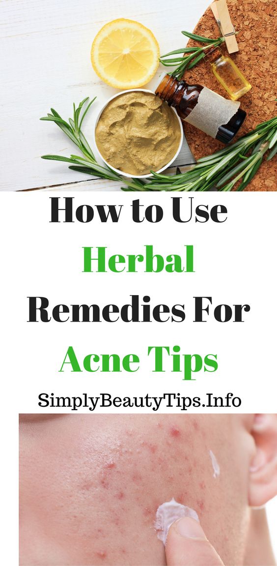 HOW TO USE HERBAL REMEDIES FOR ACNE TIPS HEALTH DIET FITNESS