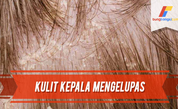 3 Cara Ampuh Mengatasi Kulit Kepala yang Mengelupas
