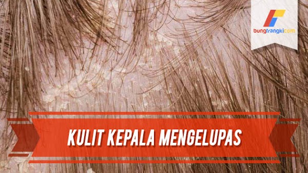 3 Cara Ampuh Mengatasi Kulit Kepala yang Mengelupas