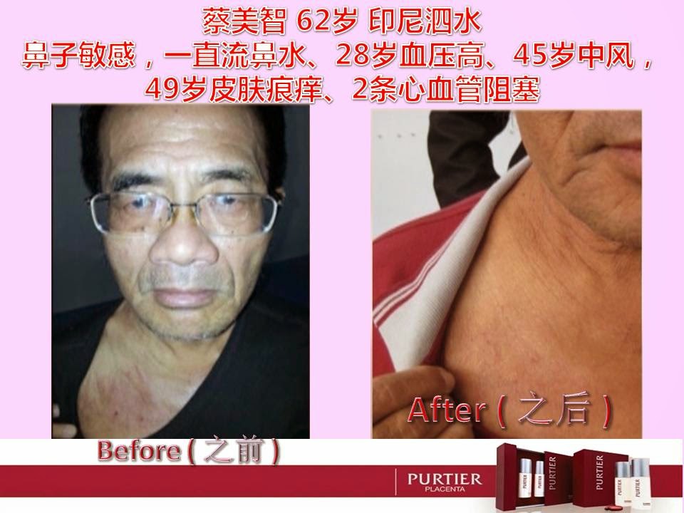MR CHAI 62 SURABAYA-SINUS,28 (HYPERTENSION),45 (STROKE),49 (SKIN DISORDER),2 HEART B.VESSELS BLOCK