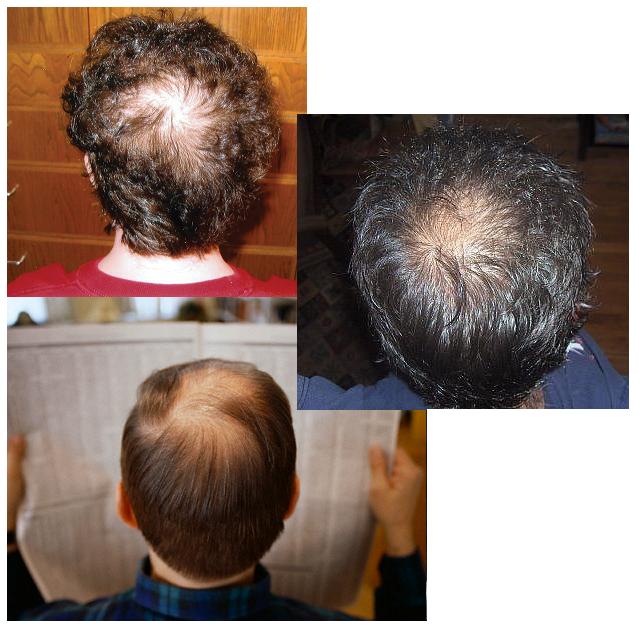 Regrow Hair How To Regrow Hair On Bald Spot