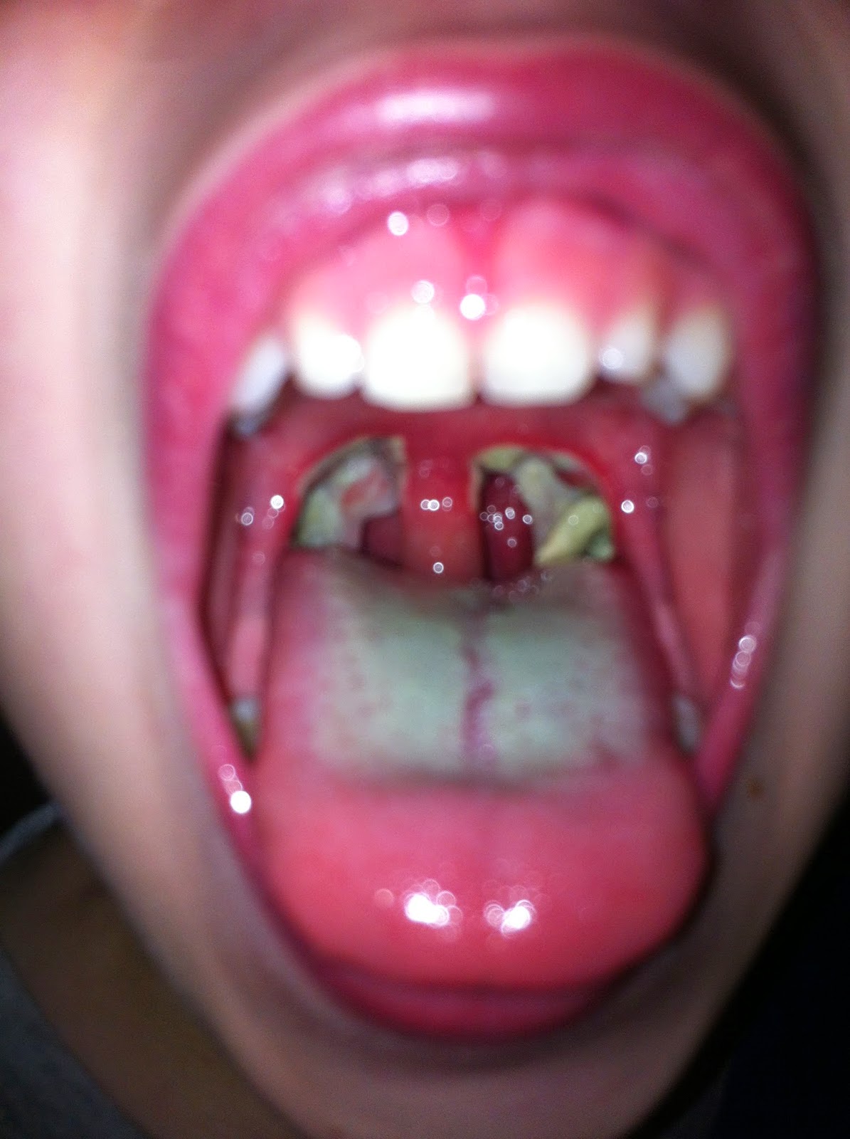 Tonsils removed deepthroat