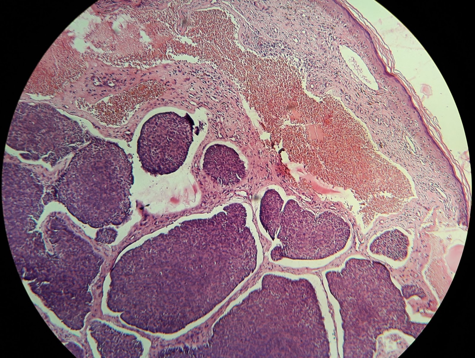 into the roots Basal cell carcinoma