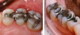 Hàn răng sâu có bền không?
