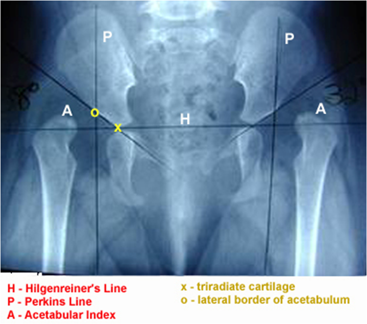 Developmental dysplasia of the hip (DDH) .