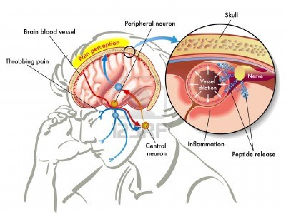 comment traiter migraine ophtalmique