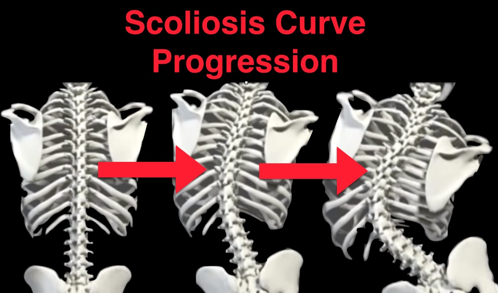 Scoliosis Progression