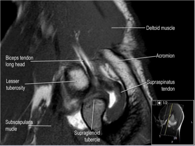 MRI Musculo-Skeletal Section: MRI anatomy of the shoulder (ABER view).