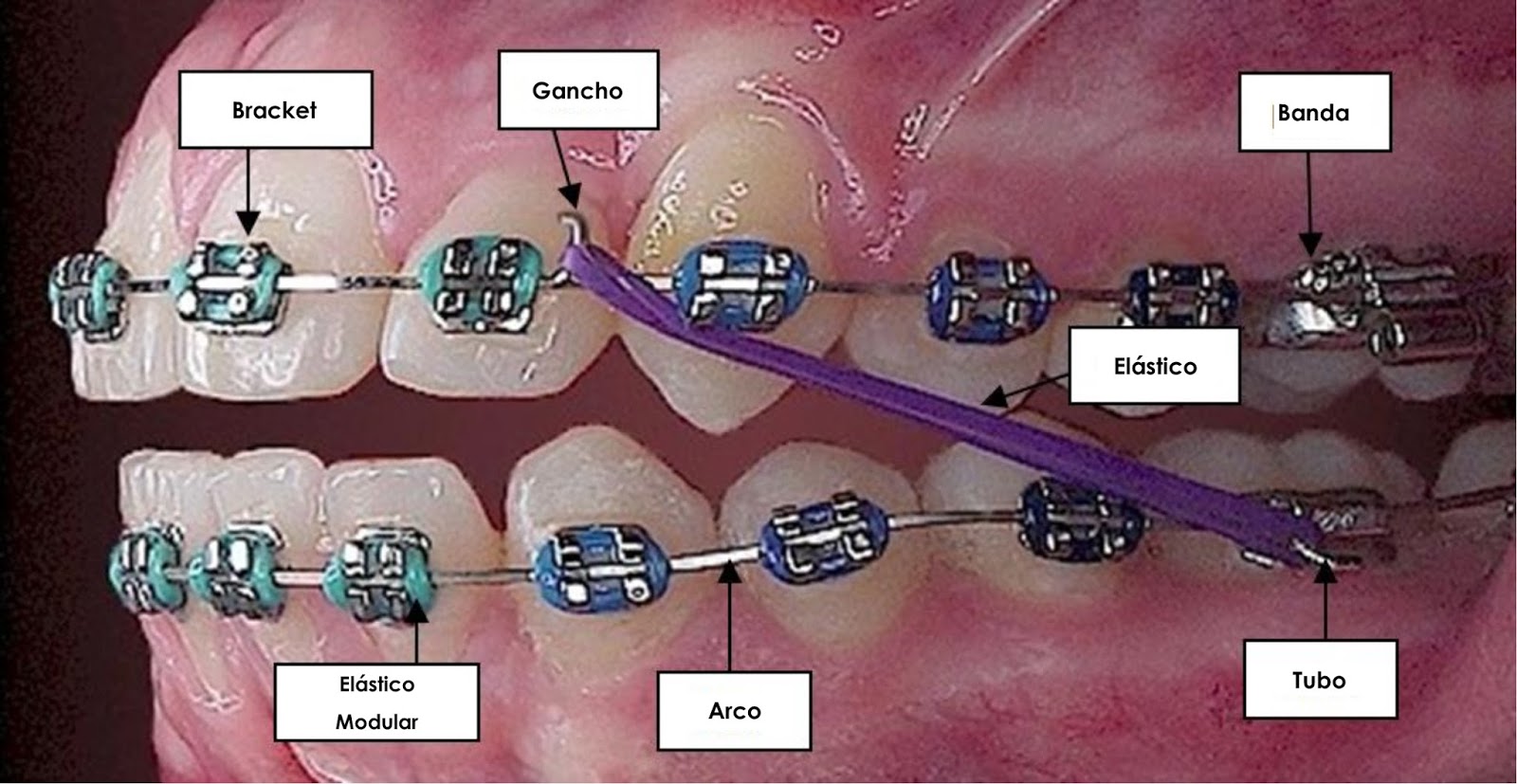 COMPONENTES DO APARELHO ORTODÔNTICO Ortodontia em Brasília