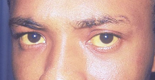 Obat alami paling ampuh mengatasi penyakit mata kuning mengatasi penyakit mata kuning