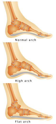 Flat Feet and Lower Back Pain | Texas Orthopedics