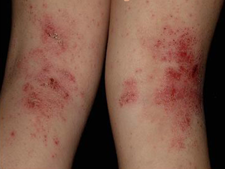 Eczema (Atopic Dermatitis) Causes, Symptoms, Treatment