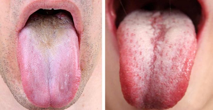 5 Alarming Signs Your Tongue Reveals About Your Health