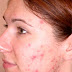 ব্রণ চিকিৎসায় হোমিওপ্যাথি ( Acne or Pimples Treatment in Homeopathy )
