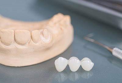 Các loại răng sứ cao cấp phổ biến