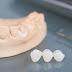 Các loại răng sứ cao cấp phổ biến