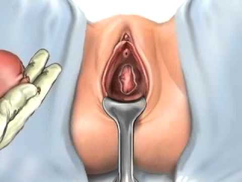 Uch orgasm soon after a hysterectomy
