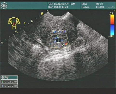 異常陰道出血 小心子宮內膜癌