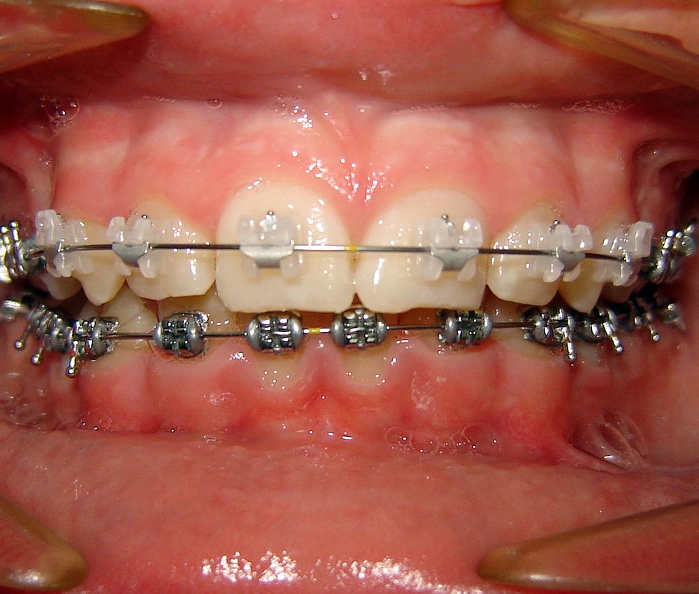 ORTODONCIA Brackets metálicos o estéticos. ¿Cuál es mejor