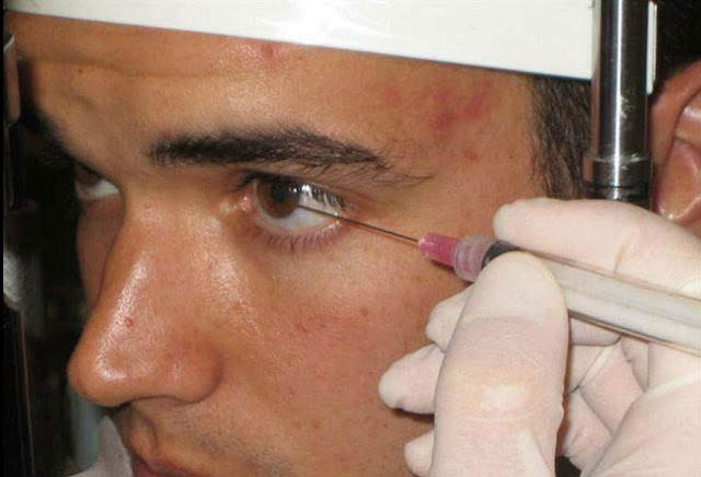 Slit lamp Fb removal Removing Foreign Body