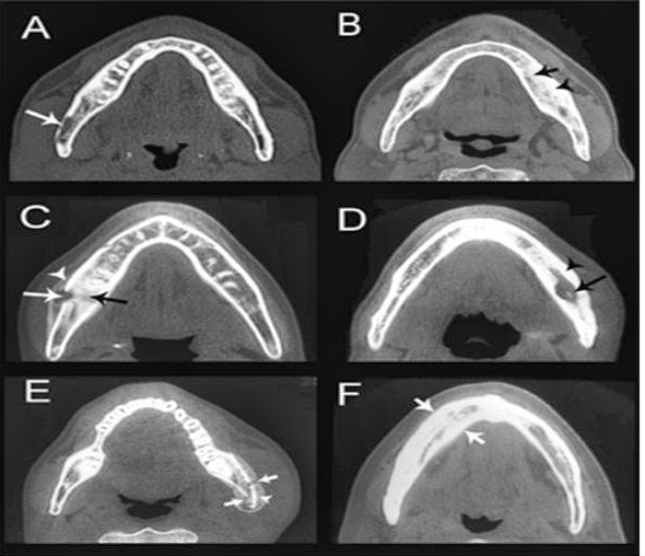 JAW OSTEOMIELITIS (osteomielitis rahang) Medical Articles