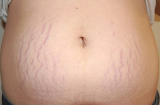 Cara Menghilangkan Stretch Mark Cara Menghilangkan Stretch Mark