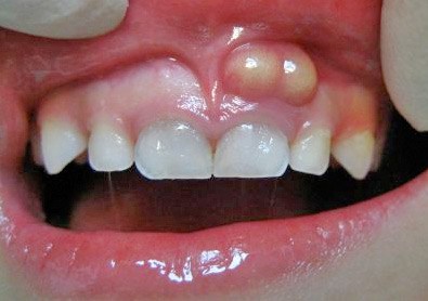 Penyebab Gejala Dan Cara Mengobati abses gigi