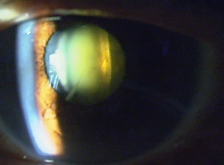 All things eye Por Yong Ming Cataract and Cataract Surgery FAQs