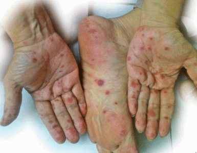 Cara Mengobati Demam Berdarah Tanpa Obat Cara Mengobati Demam Berdarah Tanpa Obat