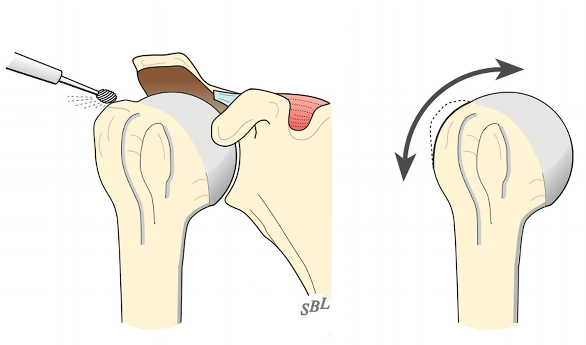 Shoulder Arthritis / Rotator Cuff Tears causes of shoulder pain