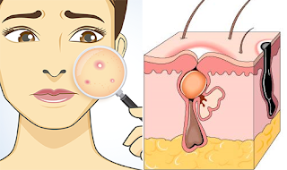 Comment se forme l'acné juvénile? ses causes et traitements. Comment se forme l'acné juvénile? ses causes et traitements.