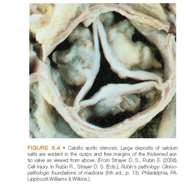 Calcific aortic stenosis. Large deposits of calcium salts are evident in the cusps and free margins of the thickened aortic valve as viewed from above.