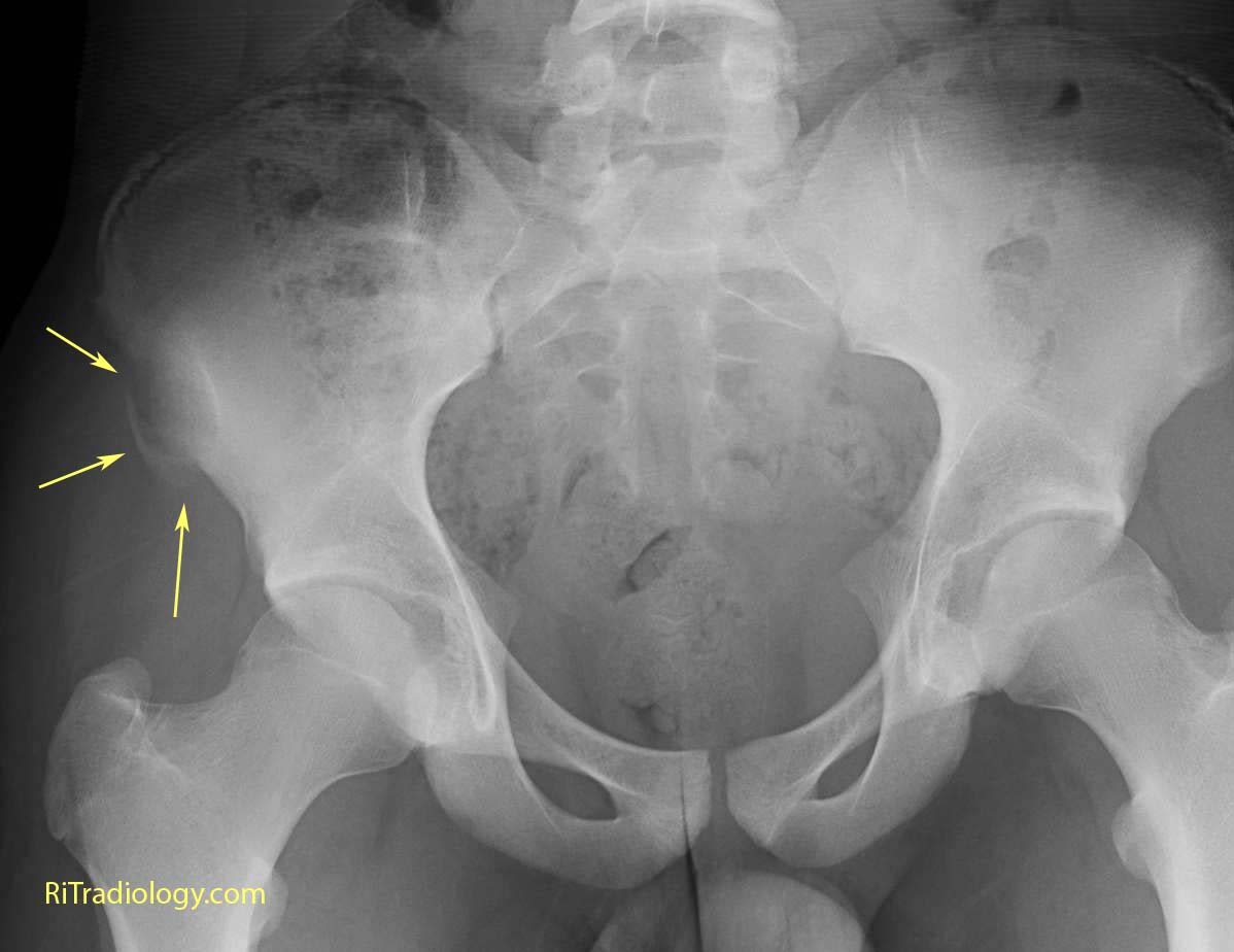 RiT radiology: Avulsion of the Anterior Superior Iliac Spine