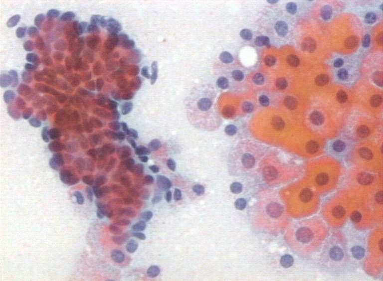 Fibrosis quistica en senos causas