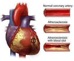 arteriosklerosis