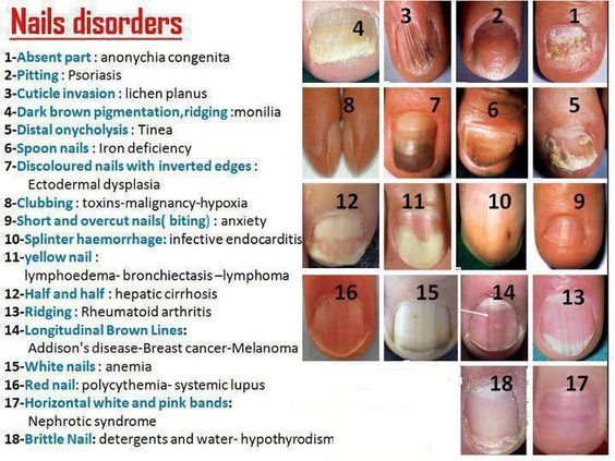 Nail abnormalities: MedlinePlus Medical Encyclopedia - wide 10