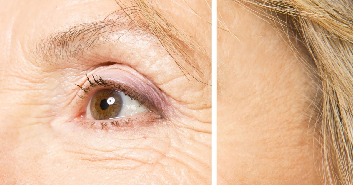 Causes and Home Remedies for Eyelid Wrinkles Eyelids Lift