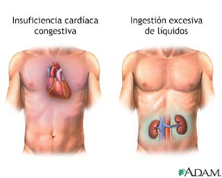 Remedios naturales para la Diabetes Insípida