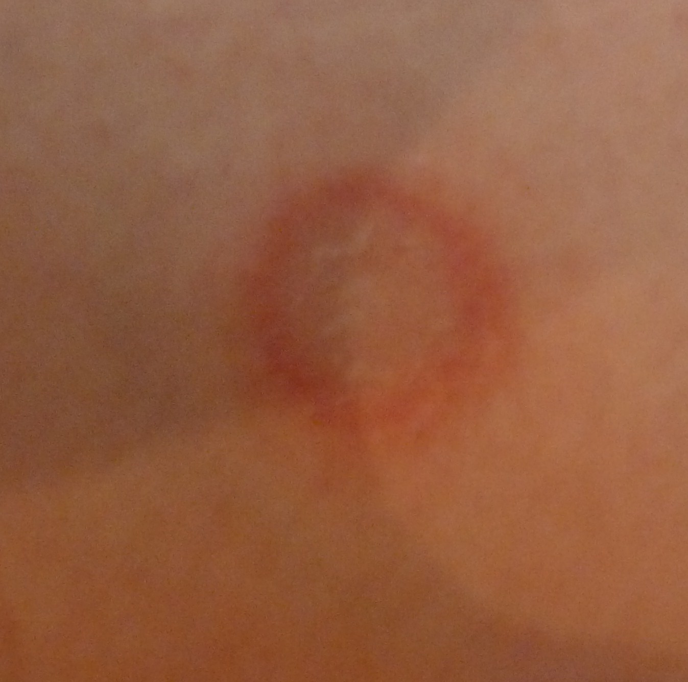 What Causes Ringworm – MedicineNet