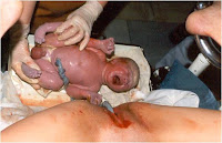 Hipotermi Pada Bayi Baru Lahir dan Neonatus