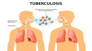 tuberculosis-www.healthnote25.com