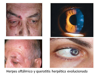 Herpes oftalmico