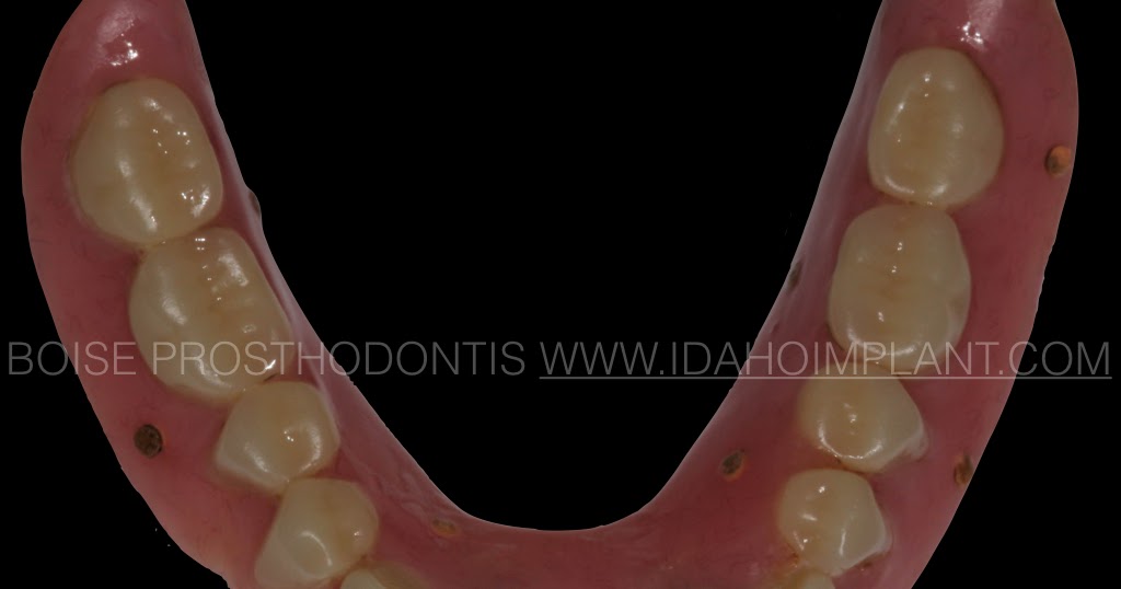 Boise Idaho Prosthodontics Technique Denture reline Improved