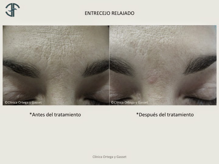 ¿hifu causa cicatrices de próstata reaction