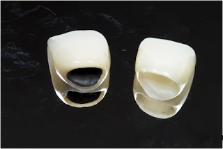 Ít người biết quy trình thực hiện bọc răng sứ 10-loi-ich-giup-ban-co-nen-boc-su-hay-khong-5