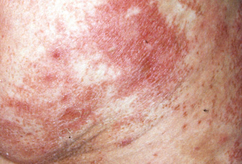# Diabetic Skin Rashes - Effects Of Alcohol On Diabetes