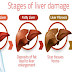These 6 Surprising Things Can Damage Your Liver