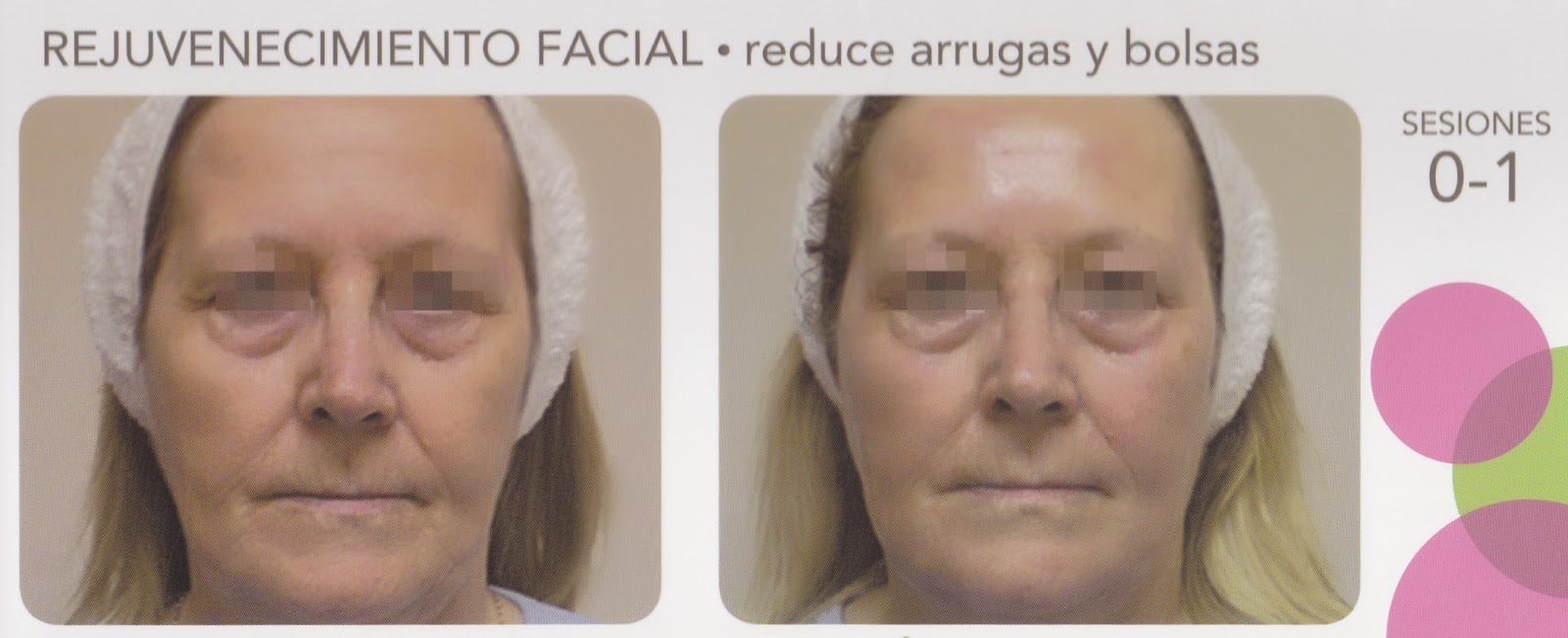 Centro de Belleza Rosi Picazo en Albacete: TRATAMIENTOS FACIALES CON INDIBA