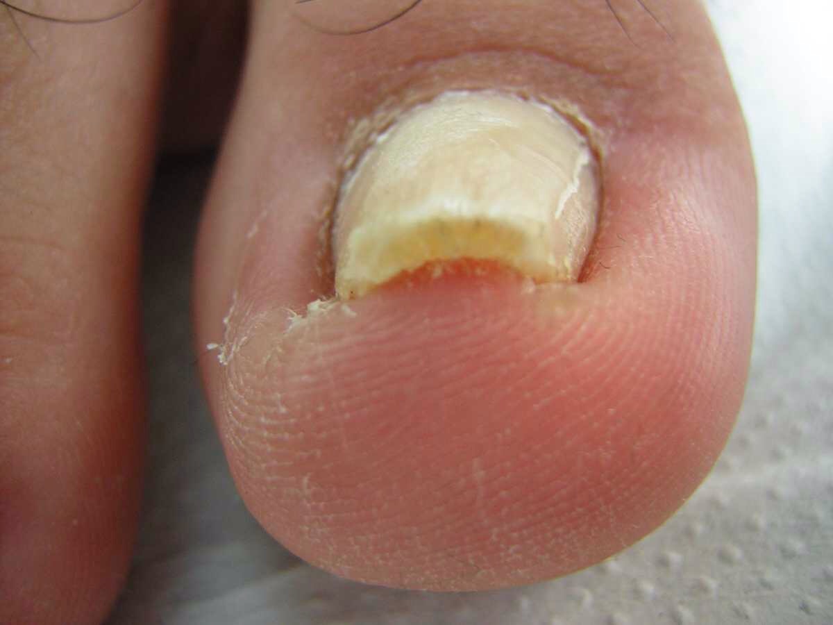Dedo Gordo Principio De Hongos En Las Uñas